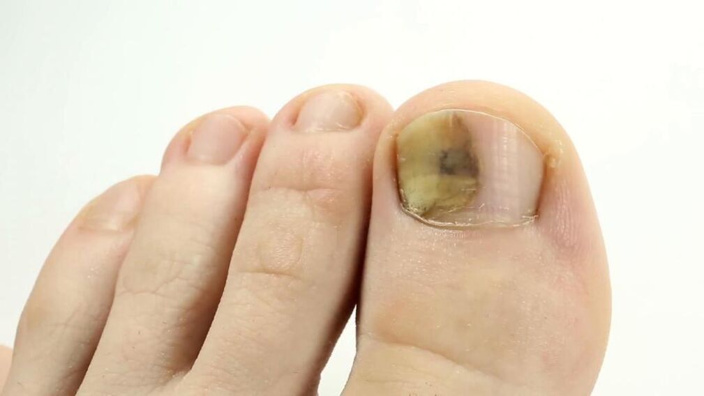 Izgled nokta na nozi zahvaćenog gljivicama
