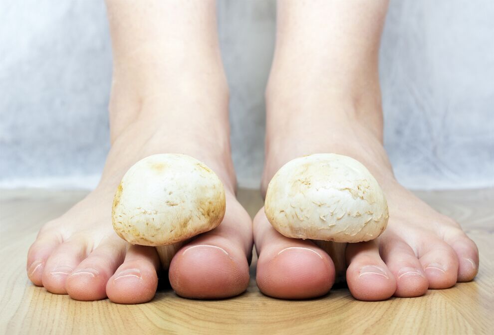 Uobičajena gljivica noktiju na nogama